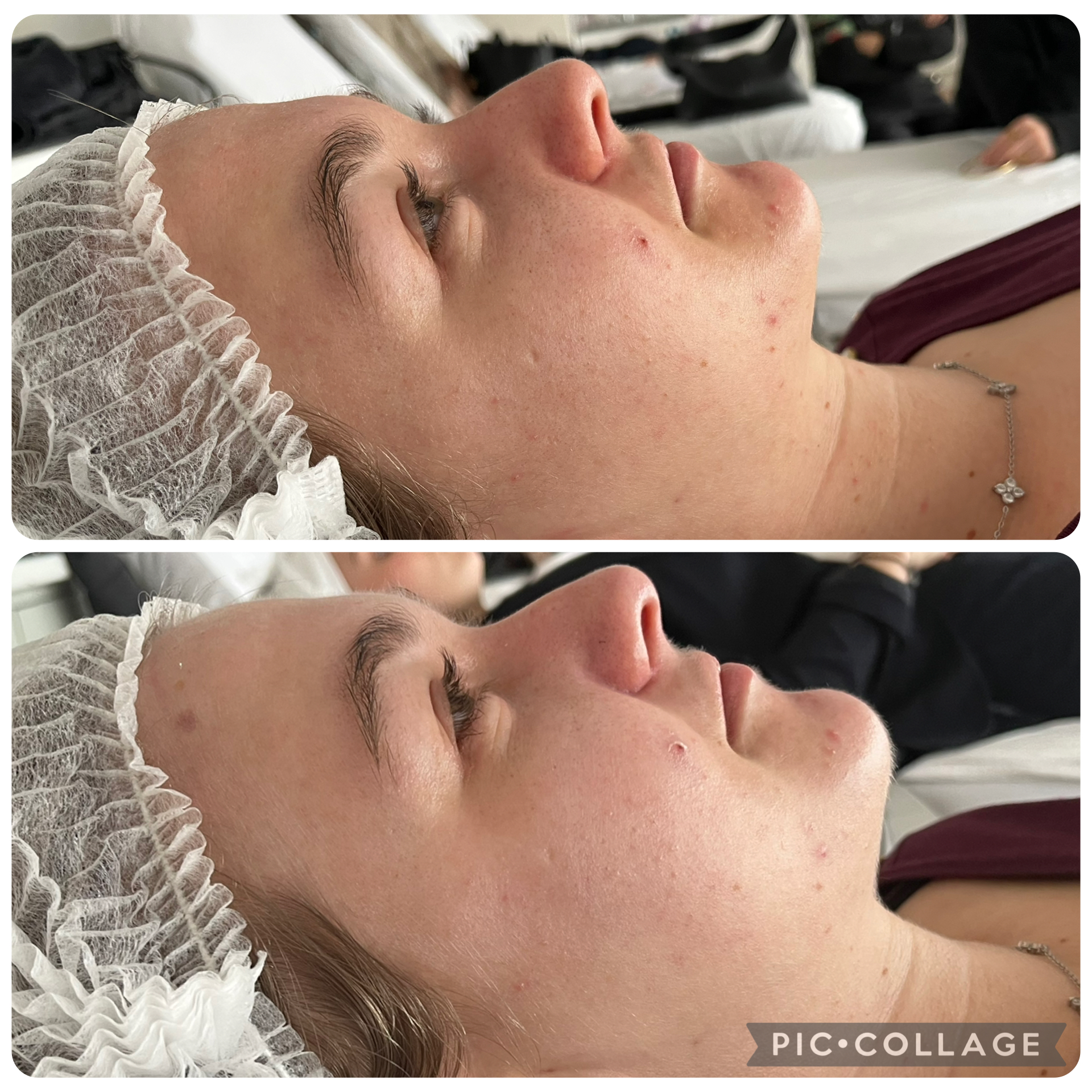 Démonstration Epiloderm soin de bio induction de collagène